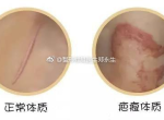 揭秘疤痕体质：成因、症状及防治策略